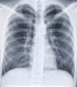 Radiographie des poumons